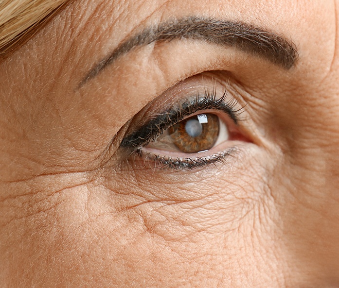 Close-up of eye of woman with cataracts in Richmond