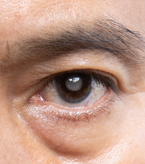 Close-up of man’s eye with cataracts