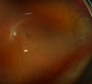 Image of patient's eye 